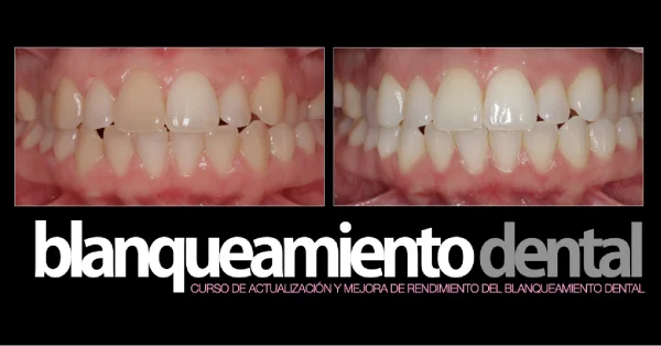 Blanqueamiento dental