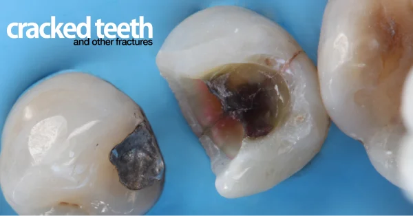 Cracked teeth y otras fracturas