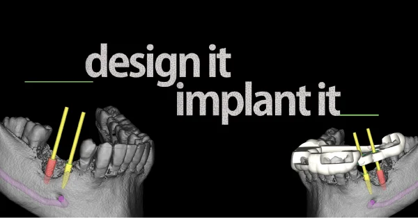 Design it_implant it_ Implantología guiada